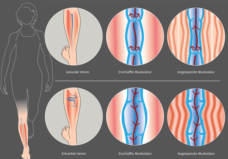 Vergleich zwischen gesunden und kranken Venen